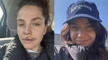 Paige Spara, atriz de The Good Doctor, revelou como ficou seu rosto após ter sido atacada por cachorro, e as fotos do antes e depois estão deixando fãs incrédulos