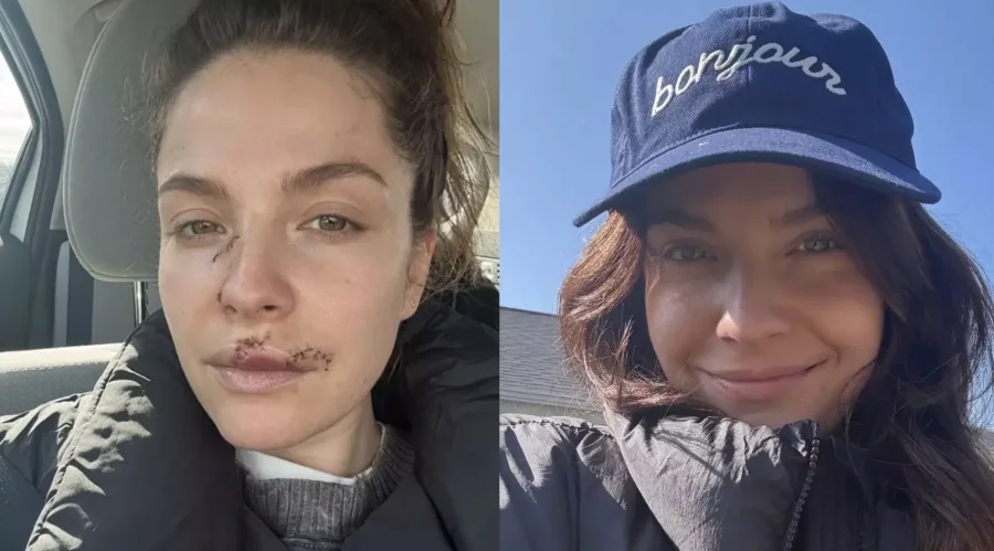 Paige Spara, atriz de The Good Doctor, revelou como ficou seu rosto após ter sido atacada por cachorro, e as fotos do antes e depois estão deixando fãs incrédulos